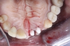 FIG.13 (visione occlusale)