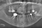 impianti-in-bioceramica-1