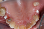 impianti-in-bioceramica-2