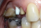impianti-in-bioceramica-3