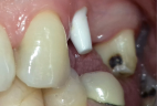 impianti-in-bioceramica-4