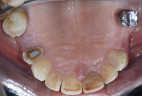 impianti-in-bioceramica-5