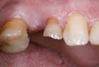 impianti-in-bioceramica-6