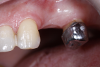 impianti-in-bioceramica-7
